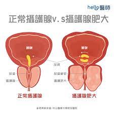 多種藥物治療良性攝護腺增生，如：犀利士