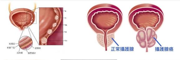 攝護腺肥大