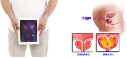 陽痿早洩疾病