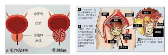 捏護腺